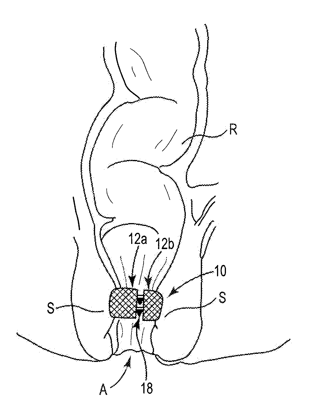 Fecal Incontinence Treatment Device and Method