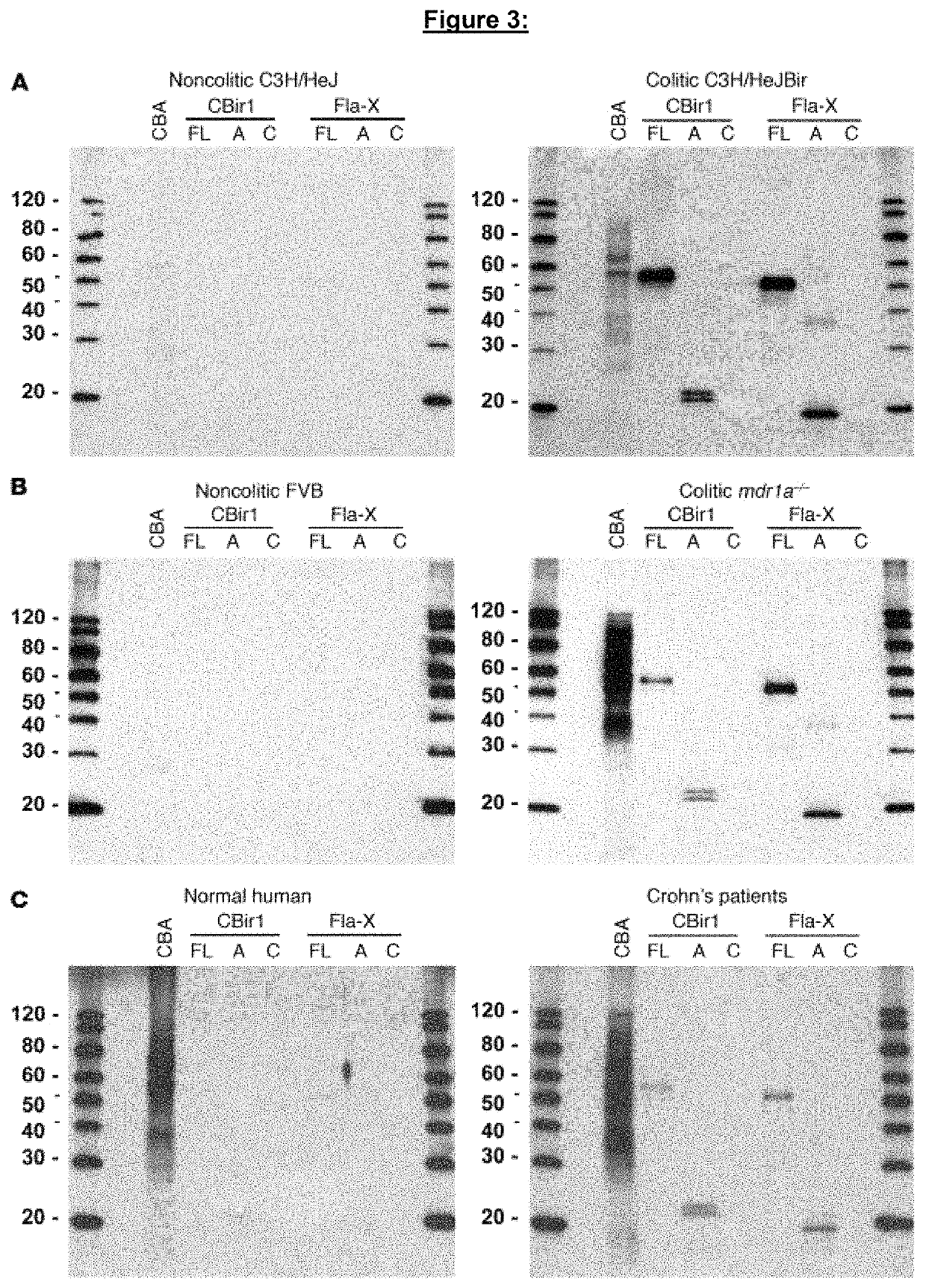 Methods of using genetic variants for the diagnosis and treatment of inflammatory bowel disease