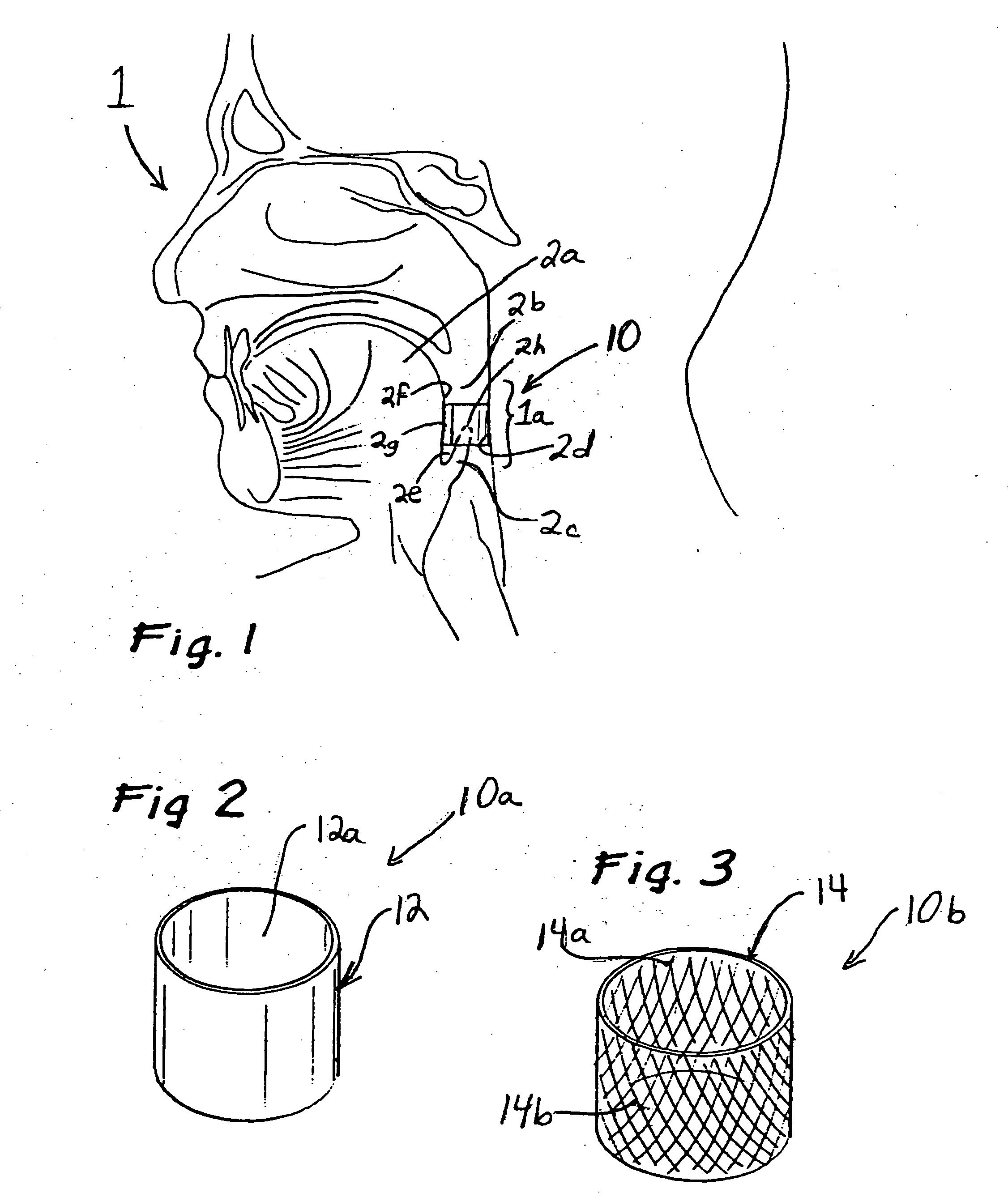 Apparatus and methods for treating sleep apnea