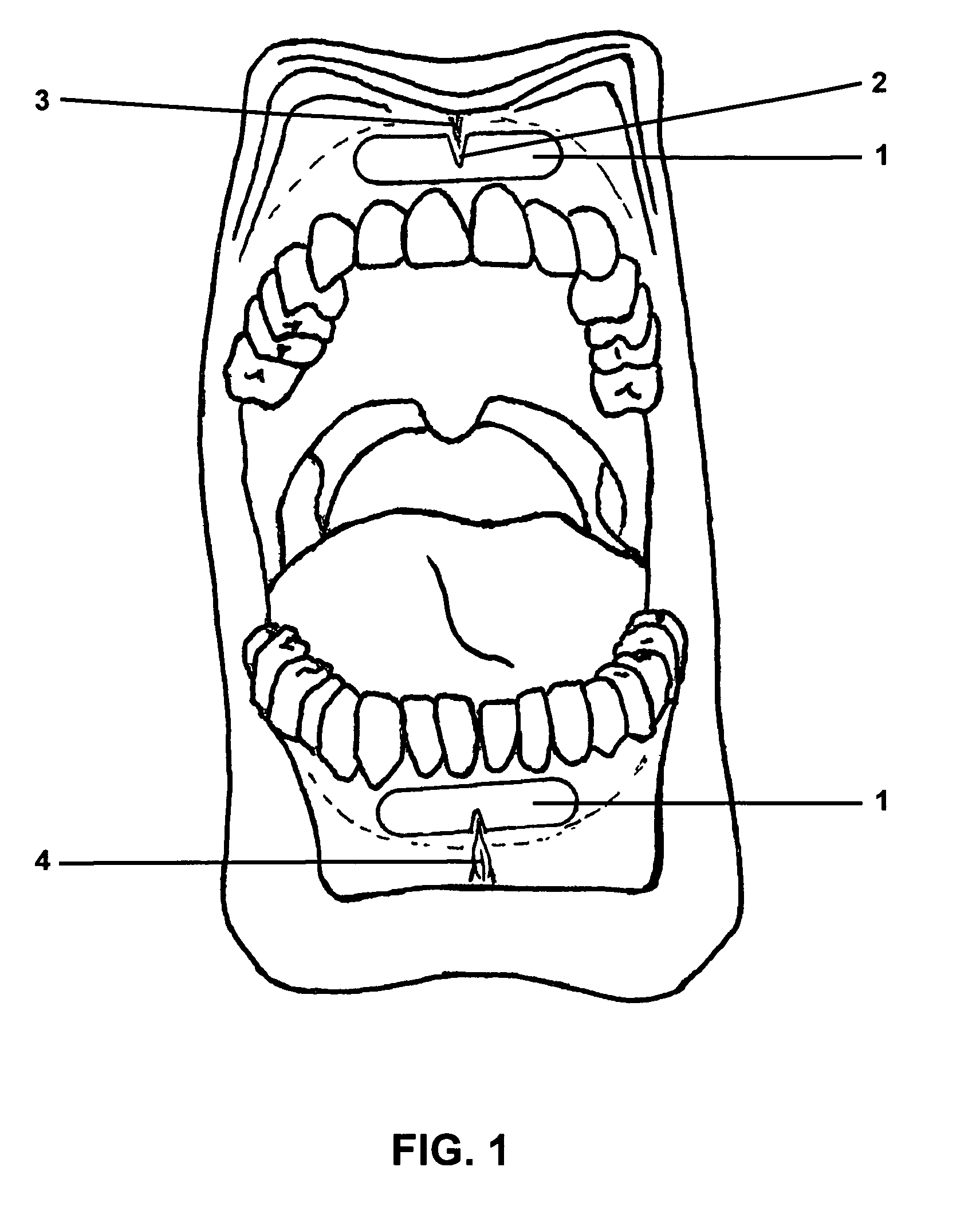 Gingival wafer