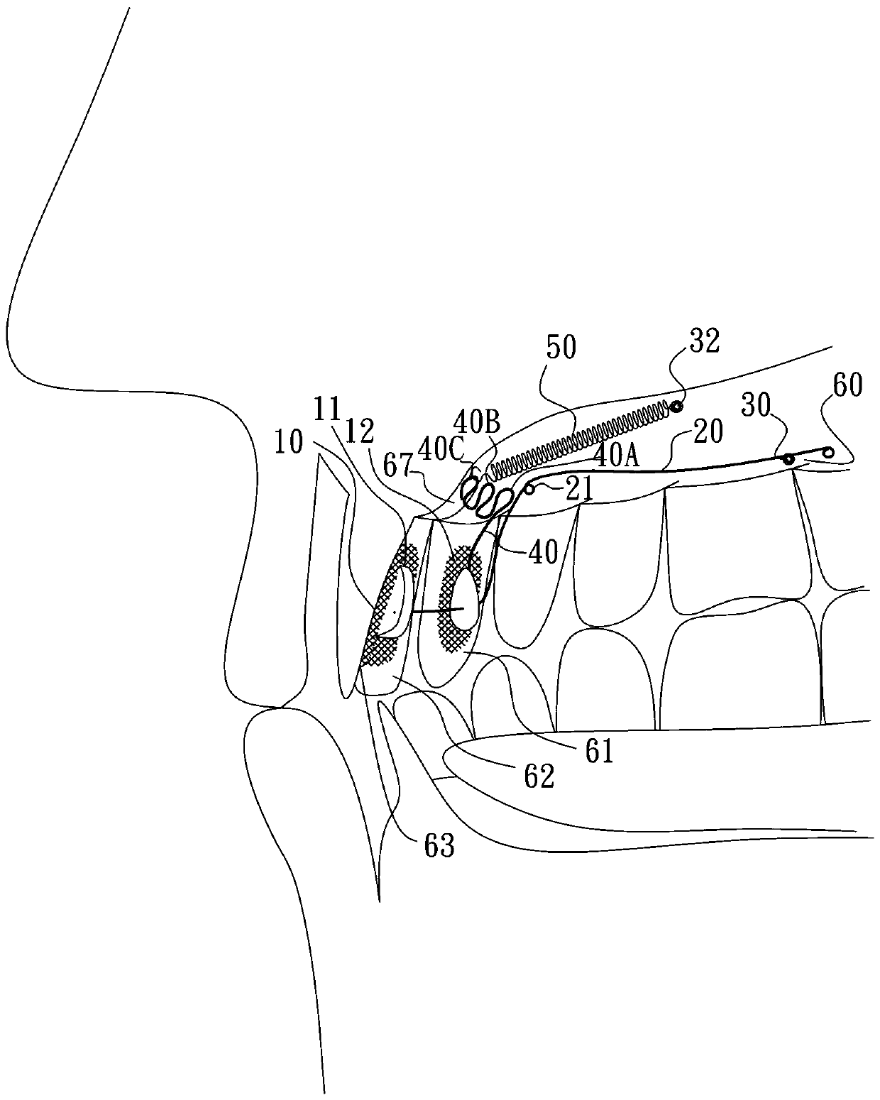 Lingual anterior teeth retractor