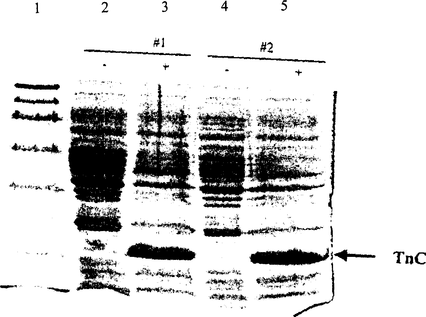 Expression of recombinant human quick skeletal muscle type troponin C in colibacillus and its application for resisting tumor