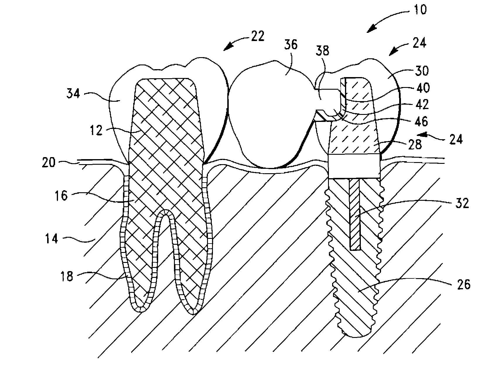 Dental Bridge