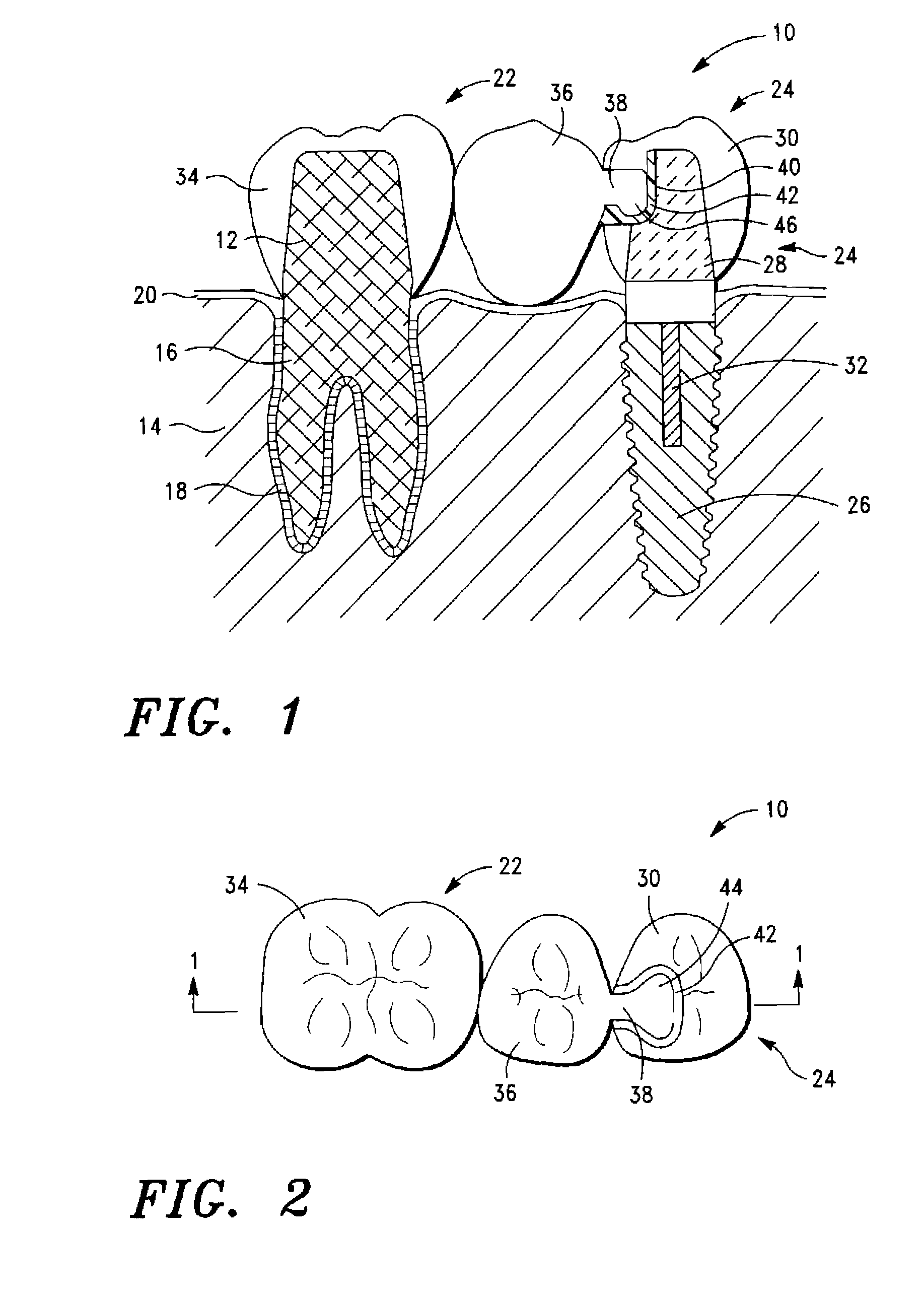 Dental Bridge