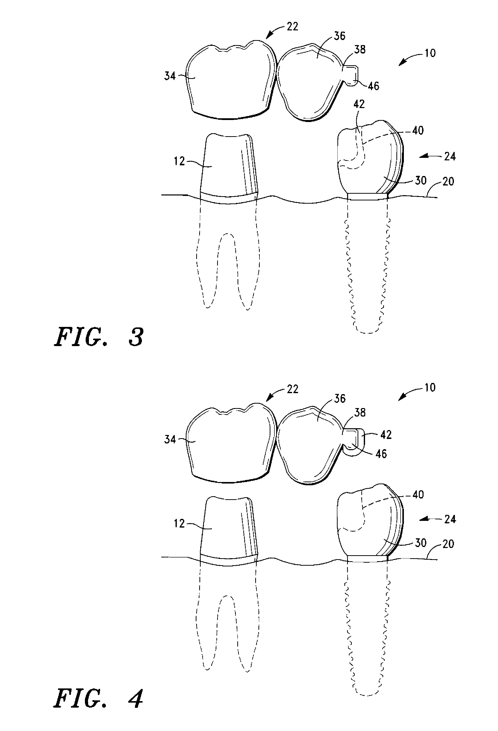 Dental Bridge