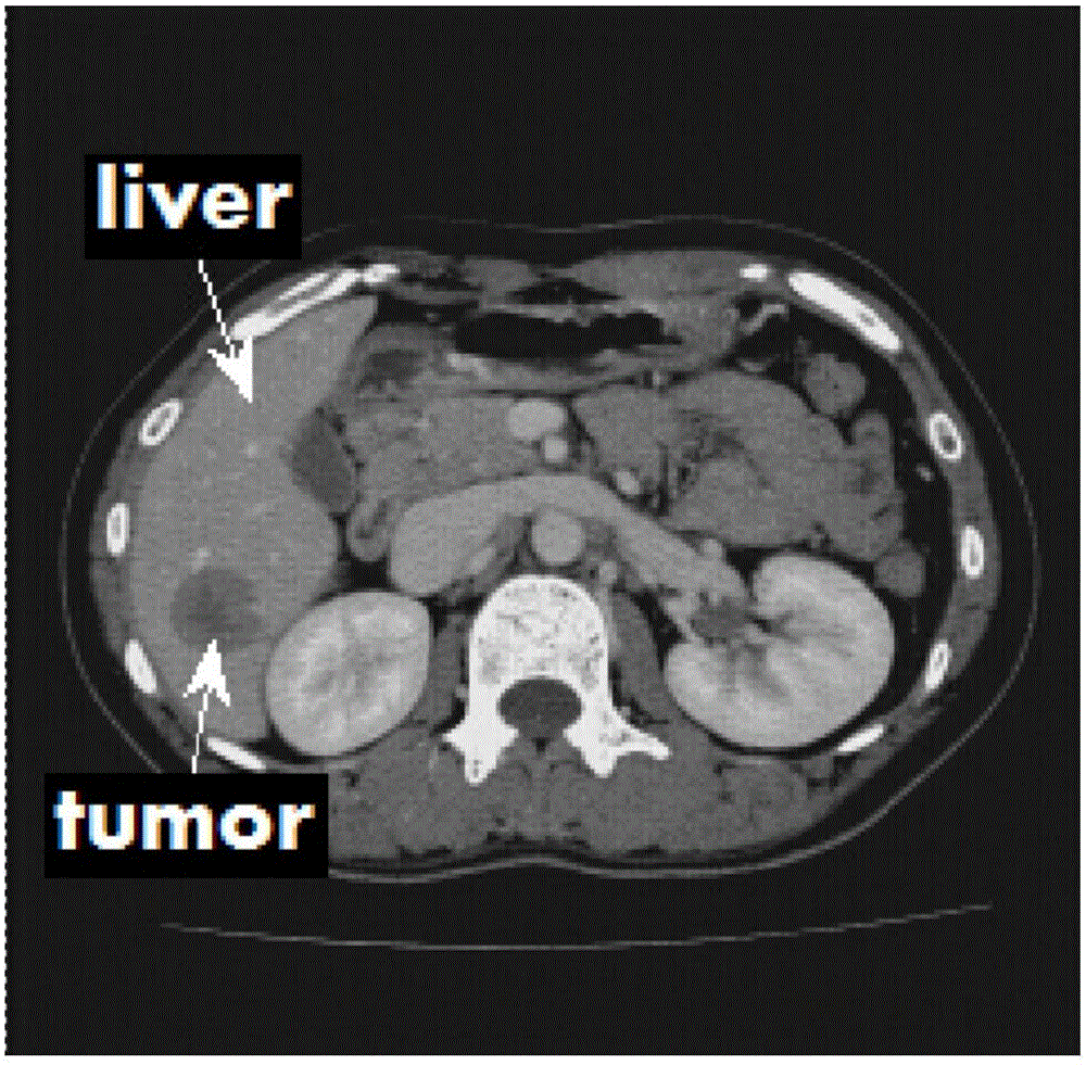 Fully-automatic three-dimensional liver segmentation method based on convolution nerve network