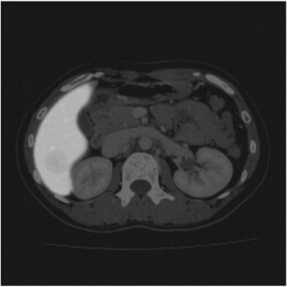 Fully-automatic three-dimensional liver segmentation method based on convolution nerve network