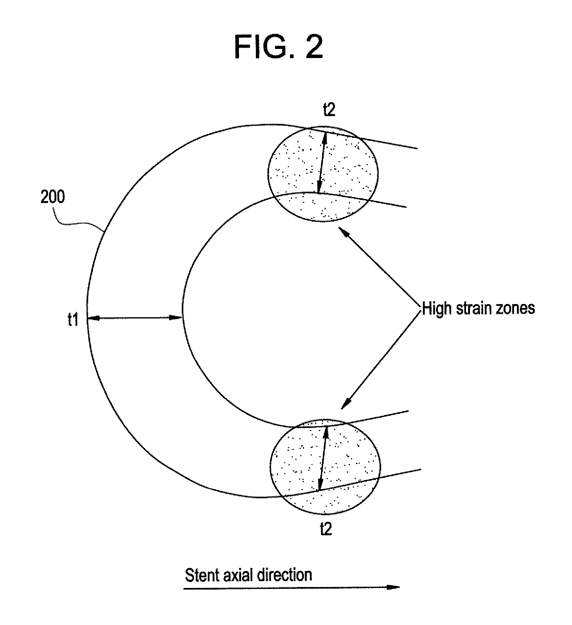 Balloon expandable bioabsorbable drug eluting flexible stent