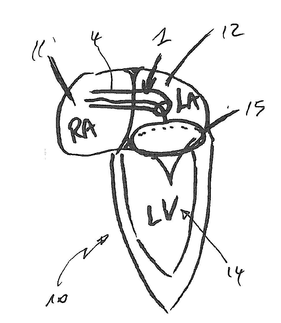 Device and Method for Reducing Cardiac Valve Regurgitation