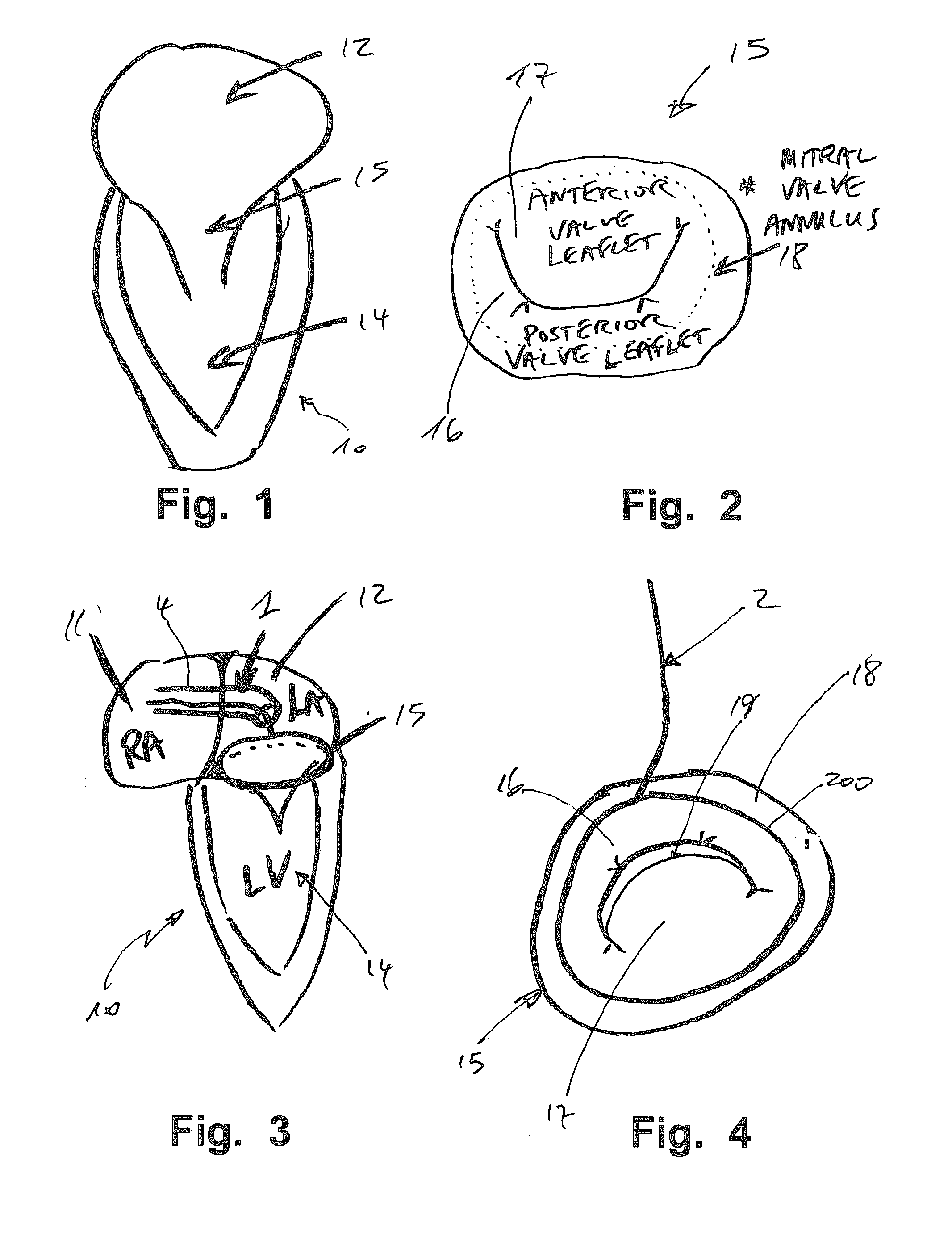 Device and Method for Reducing Cardiac Valve Regurgitation