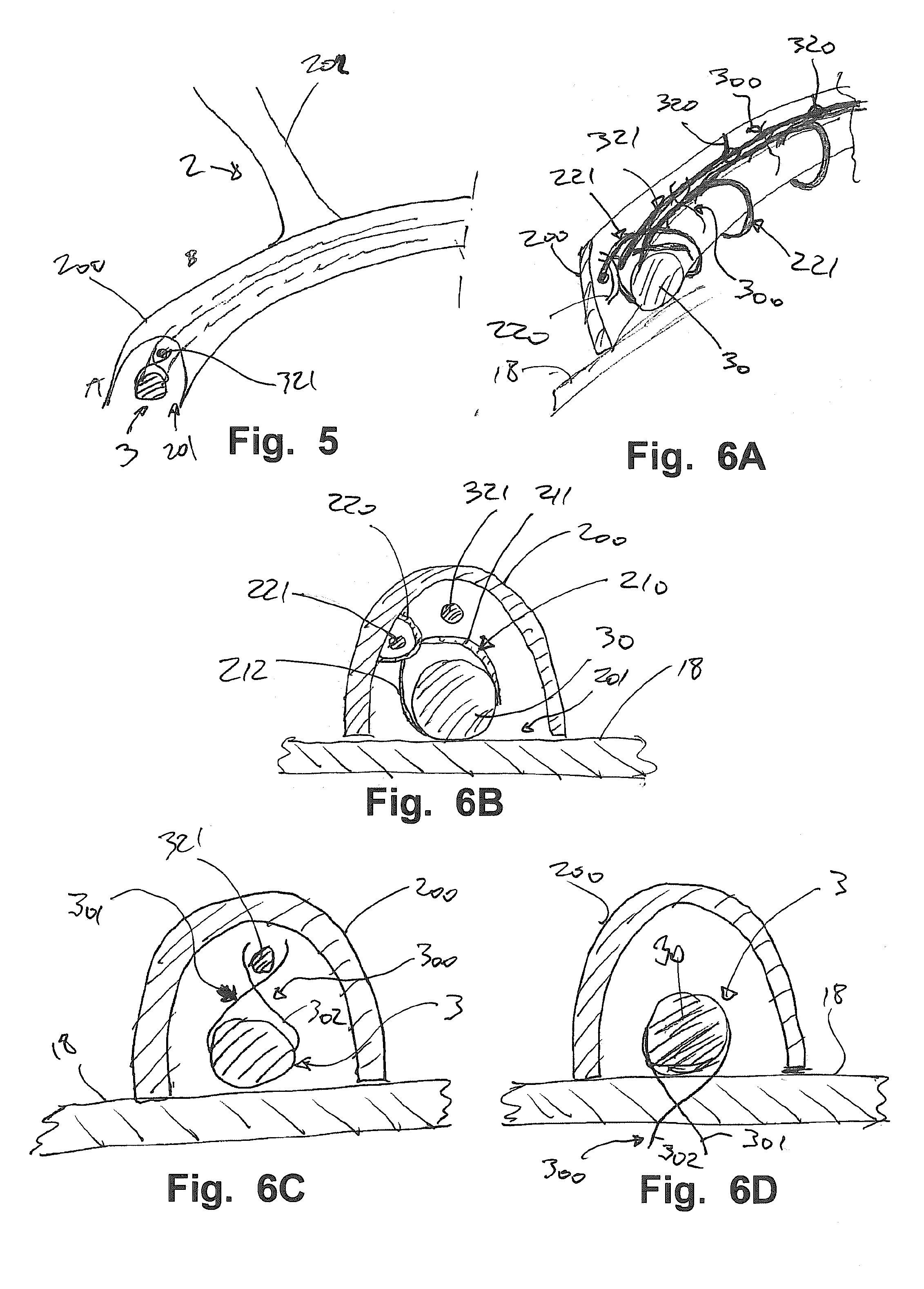 Device and Method for Reducing Cardiac Valve Regurgitation