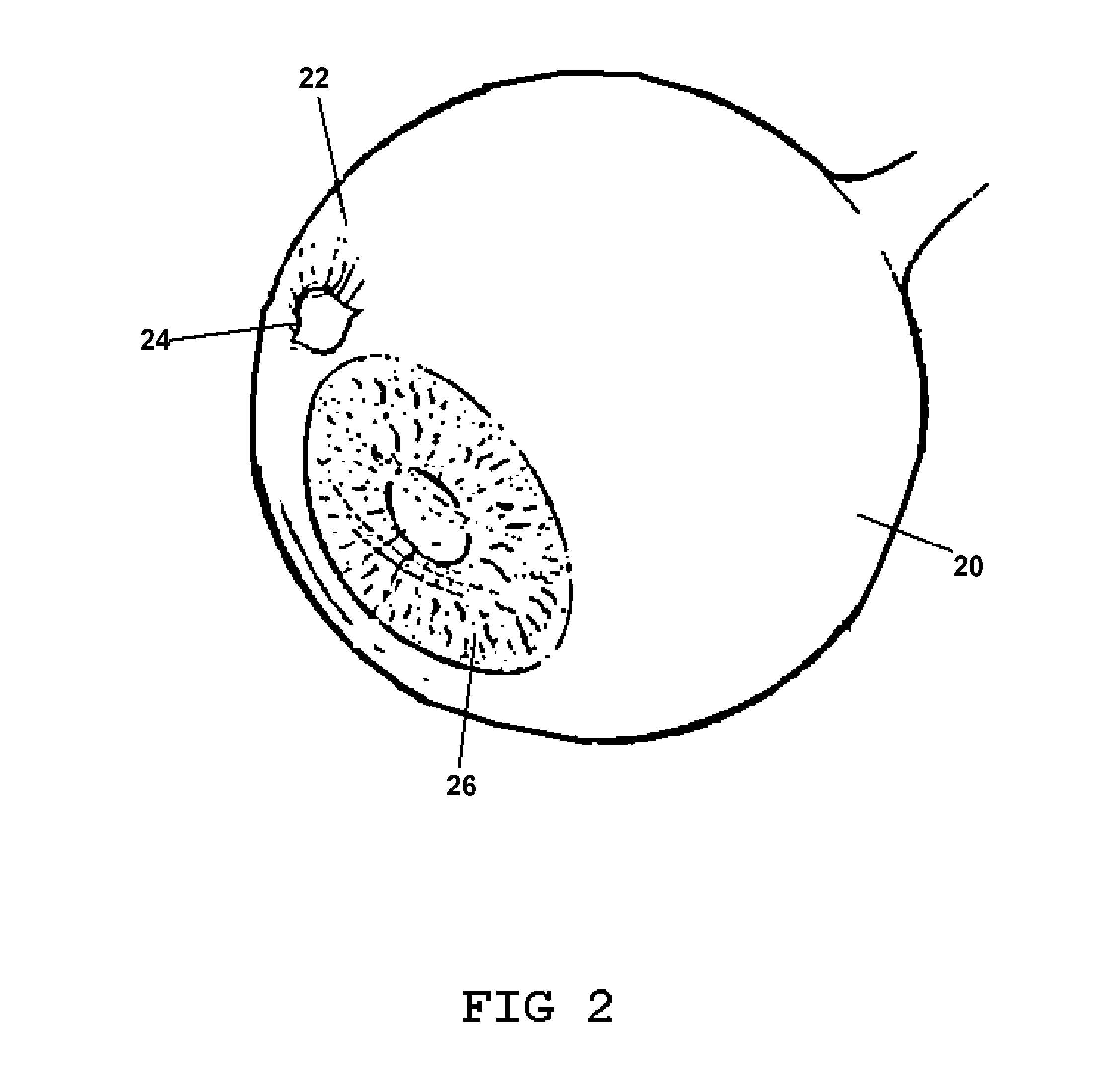 Apparatus and method for lowering intraocular pressure in an eye