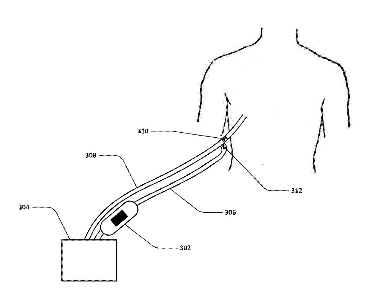 Devices and methods for managing chest drainage