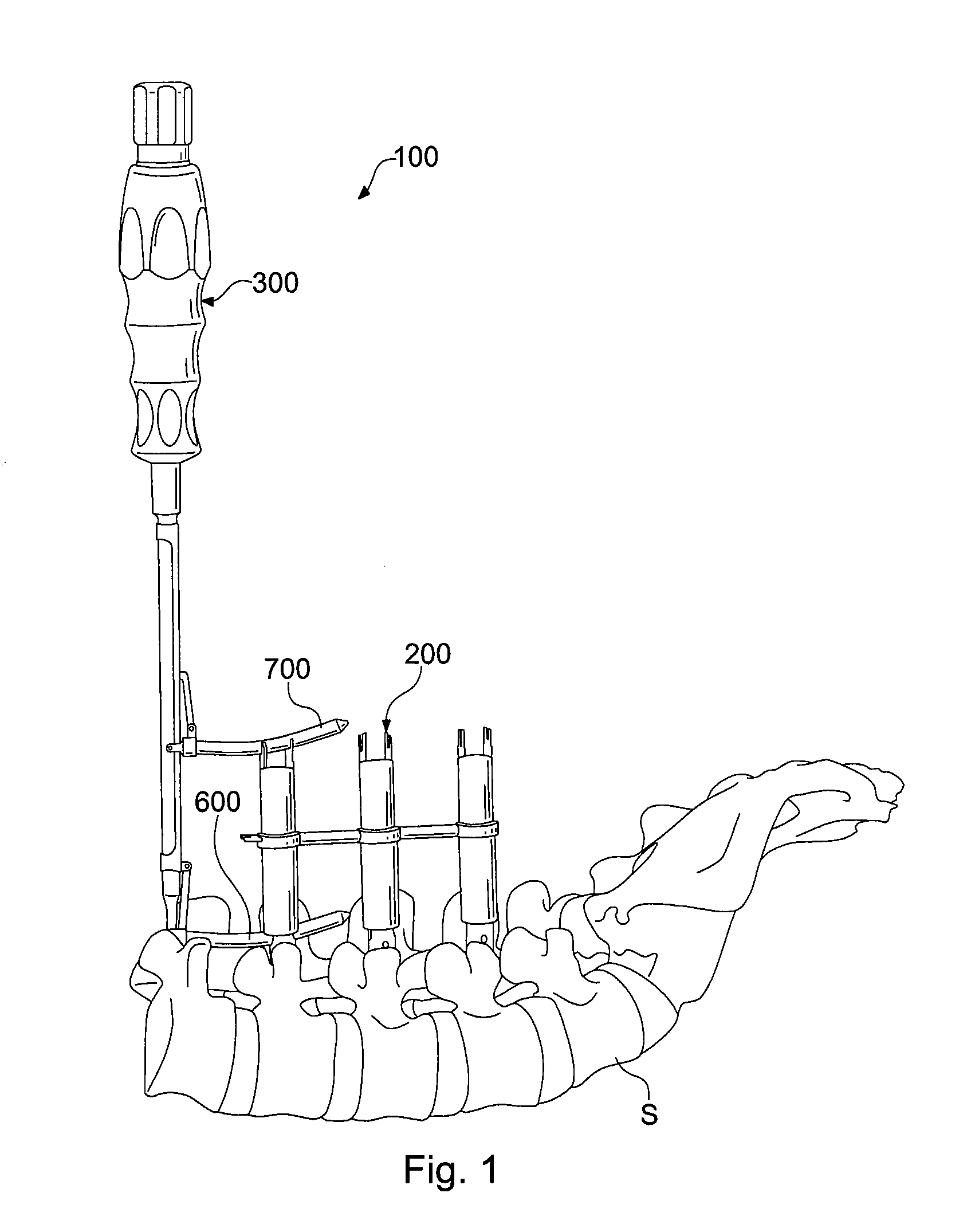 Percutaneous rod insertion system and method