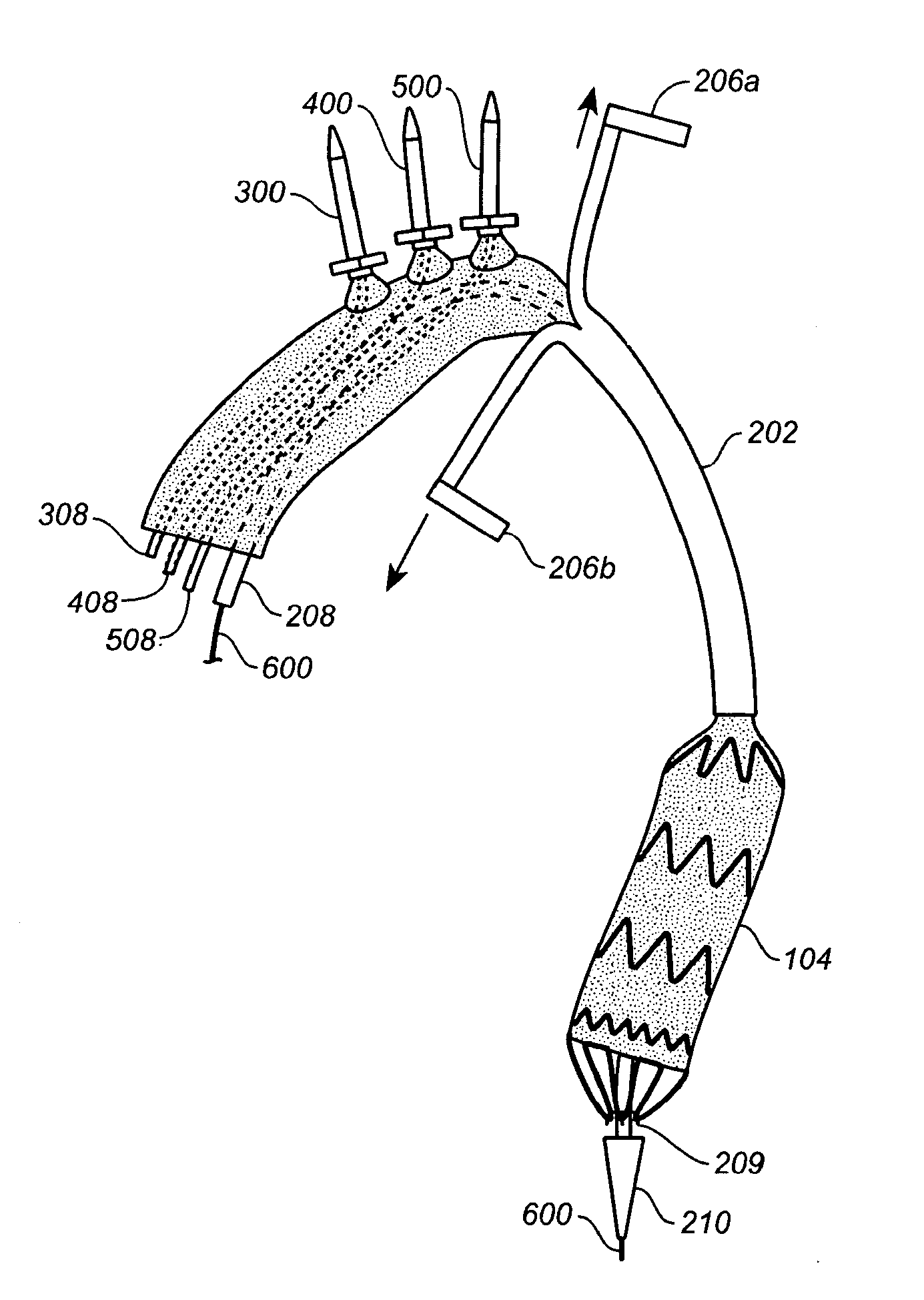 Prosthesis for antegrade deployment