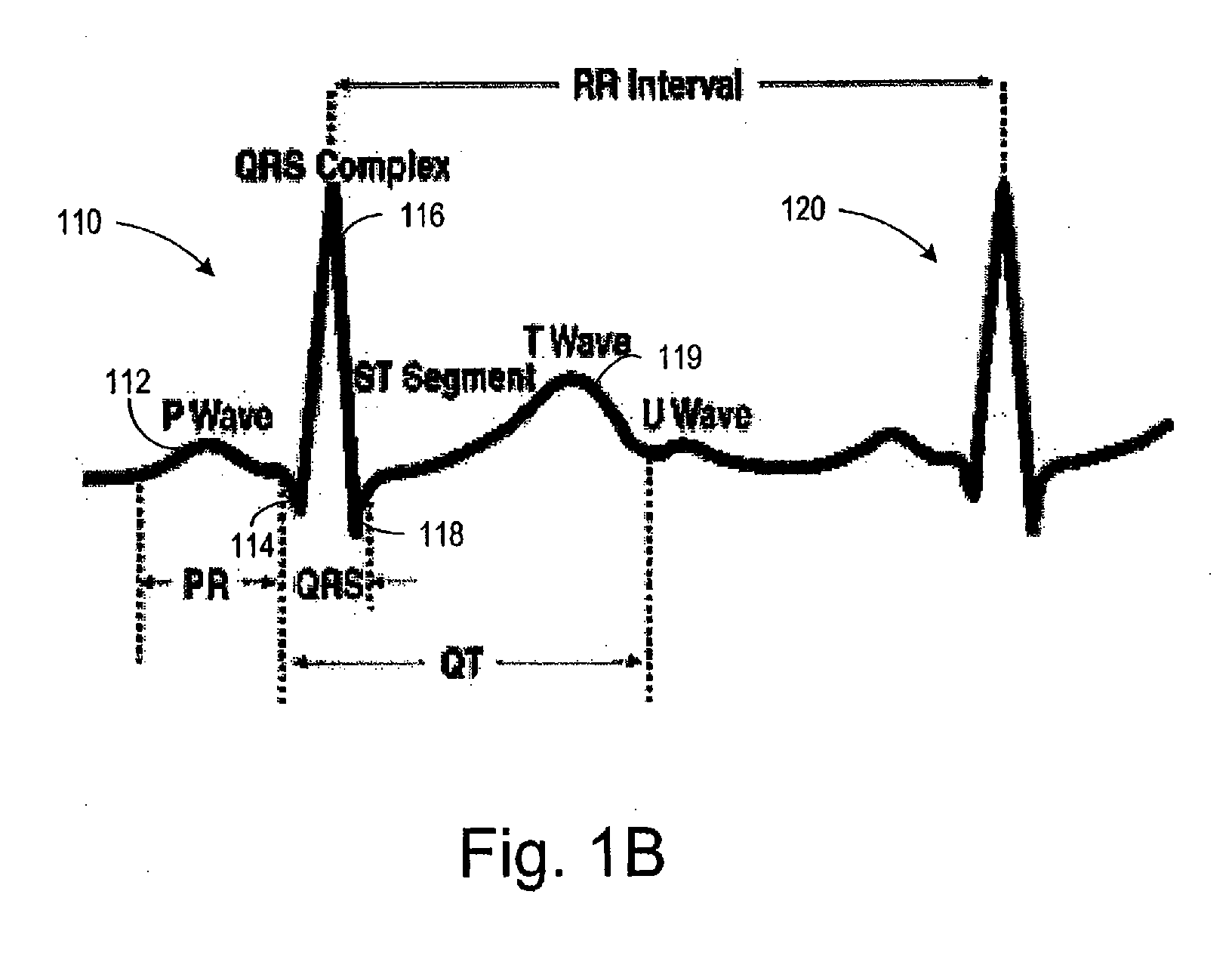 Rejection of noises caused by postural changes during acute myocardial infarction detection