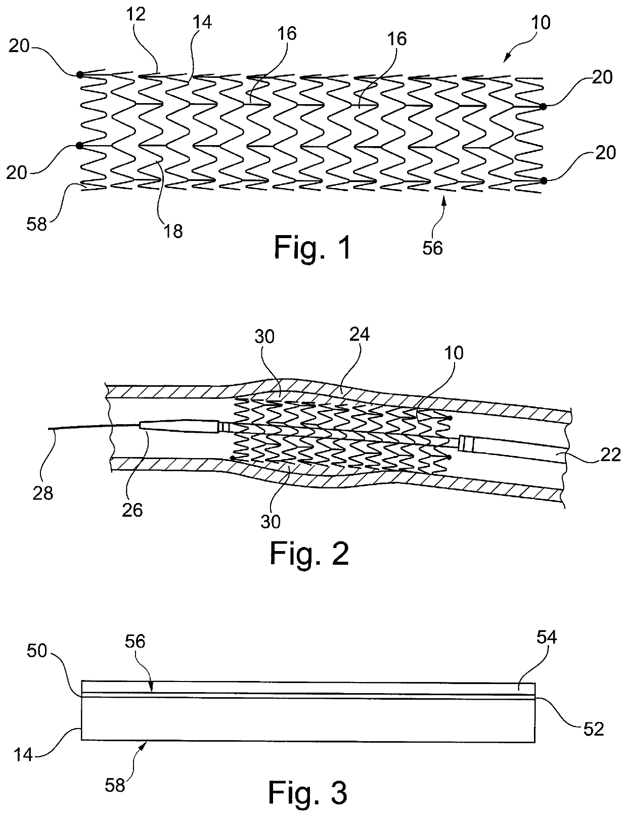 Implantable medical device with differentiated luminal and abluminal characteristics