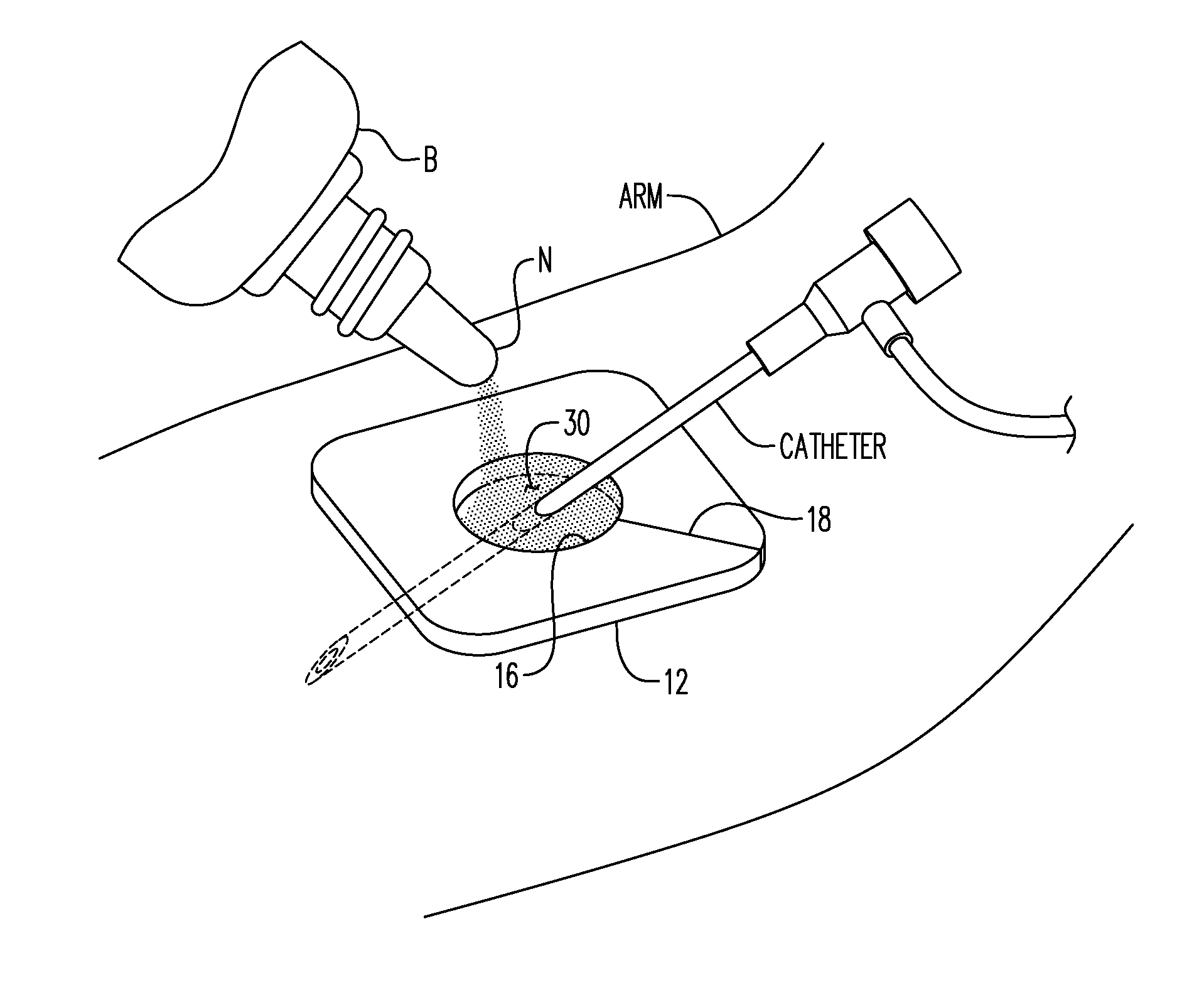 Method of Reducing Infections and/or Air Embolisms Associated with Vascular Access Procedures