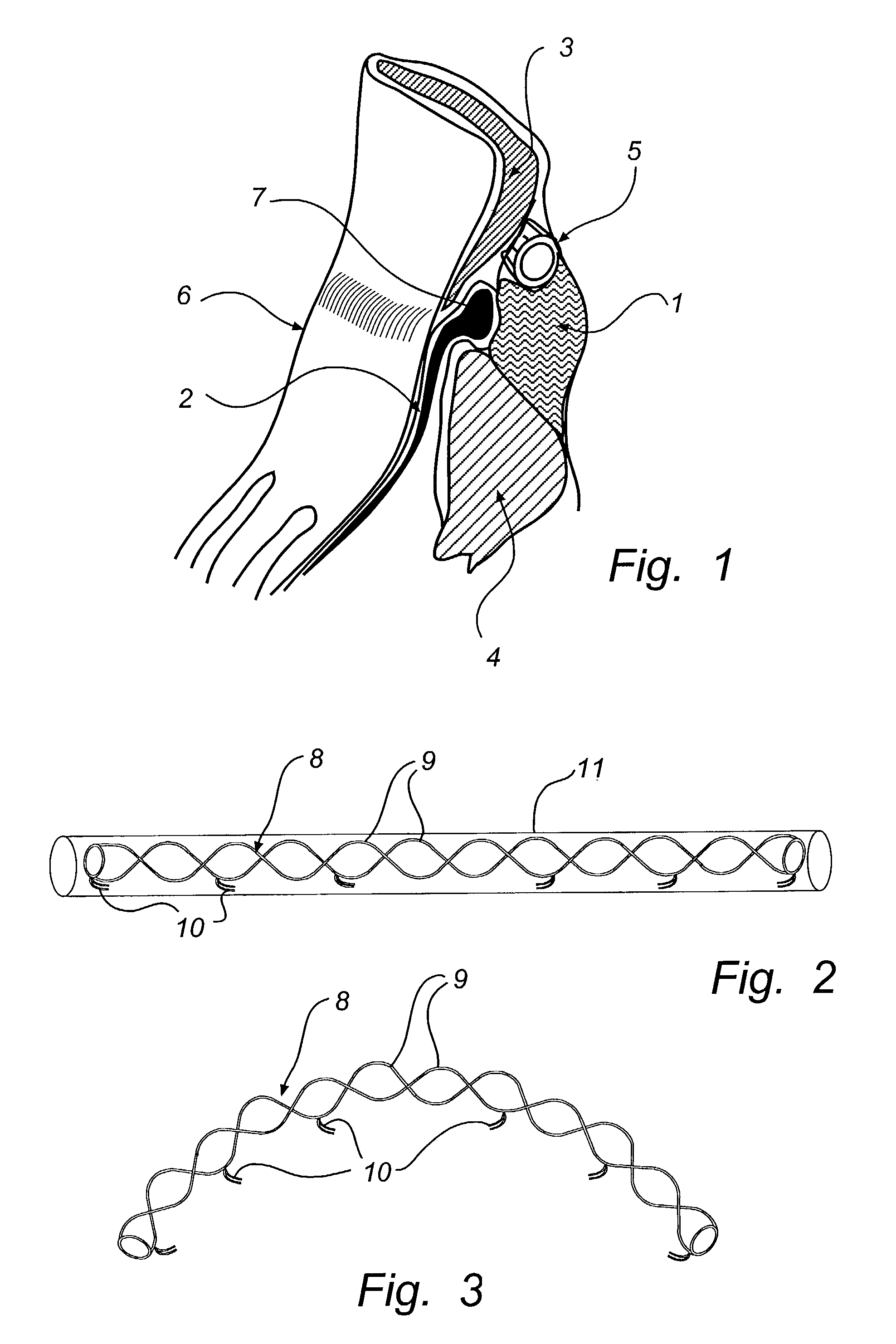 Method for treatment of mitral insufficiency