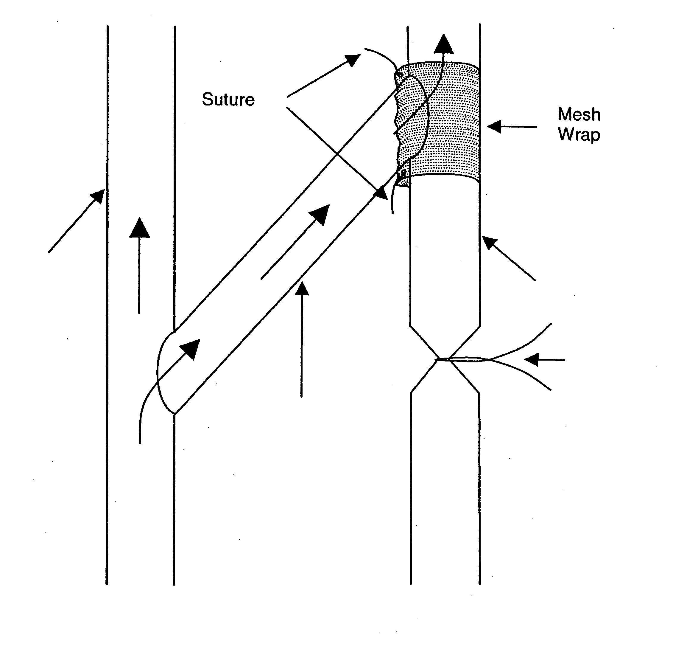 Perivascular wraps