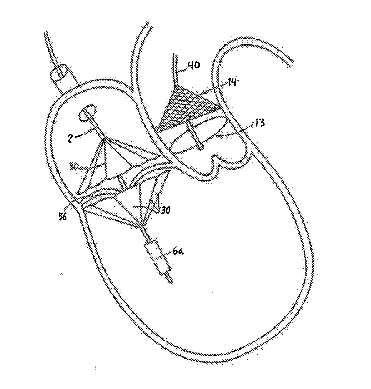 Prosthetic Valve for Transluminal Delivery