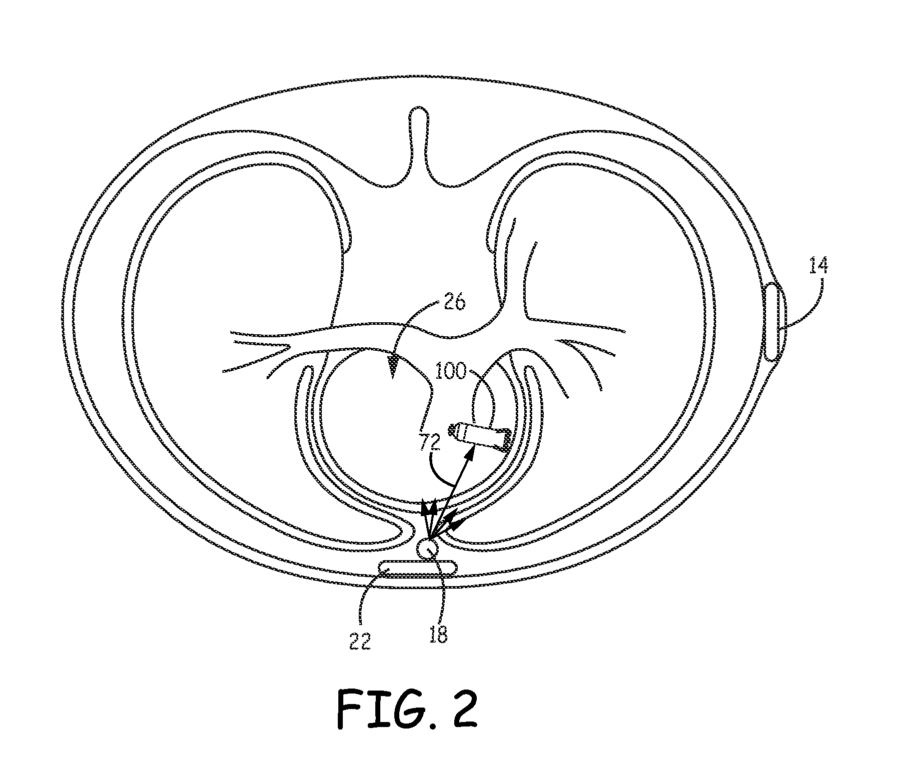 Confirming sensed atrial events for pacing during resynchronization therapy in a cardiac medical device and medical device system