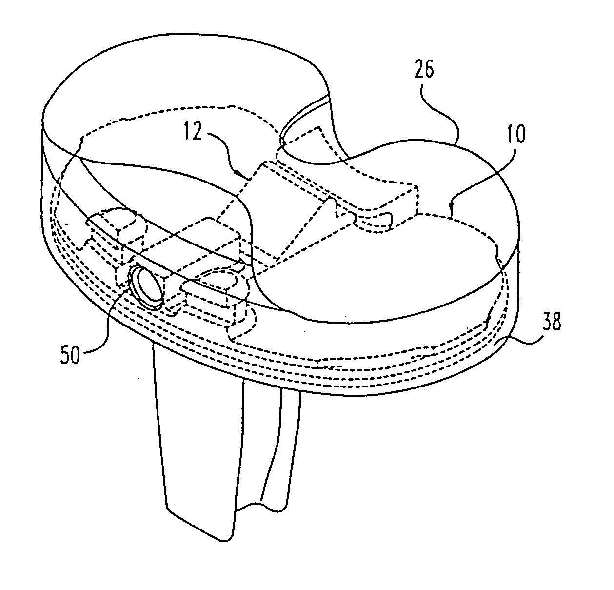 Tibial prosthesis convertible in vivo to a modular prosthesis