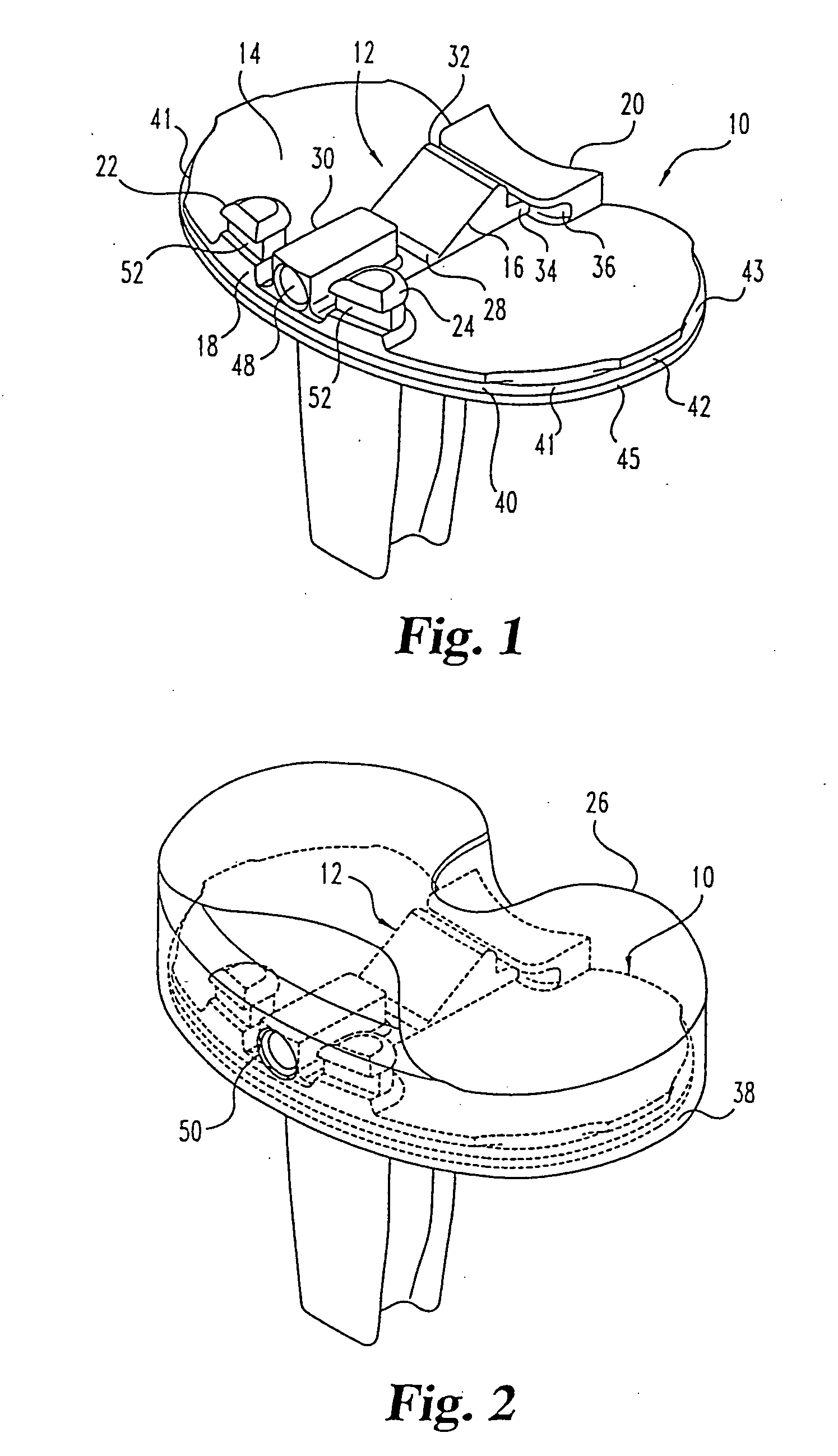 Tibial prosthesis convertible in vivo to a modular prosthesis