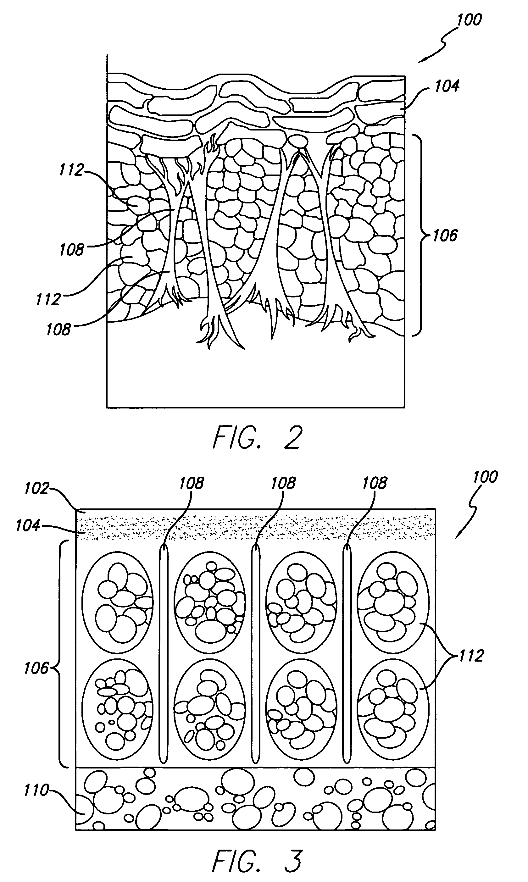 Apparatus for treating subcutaneous tissues