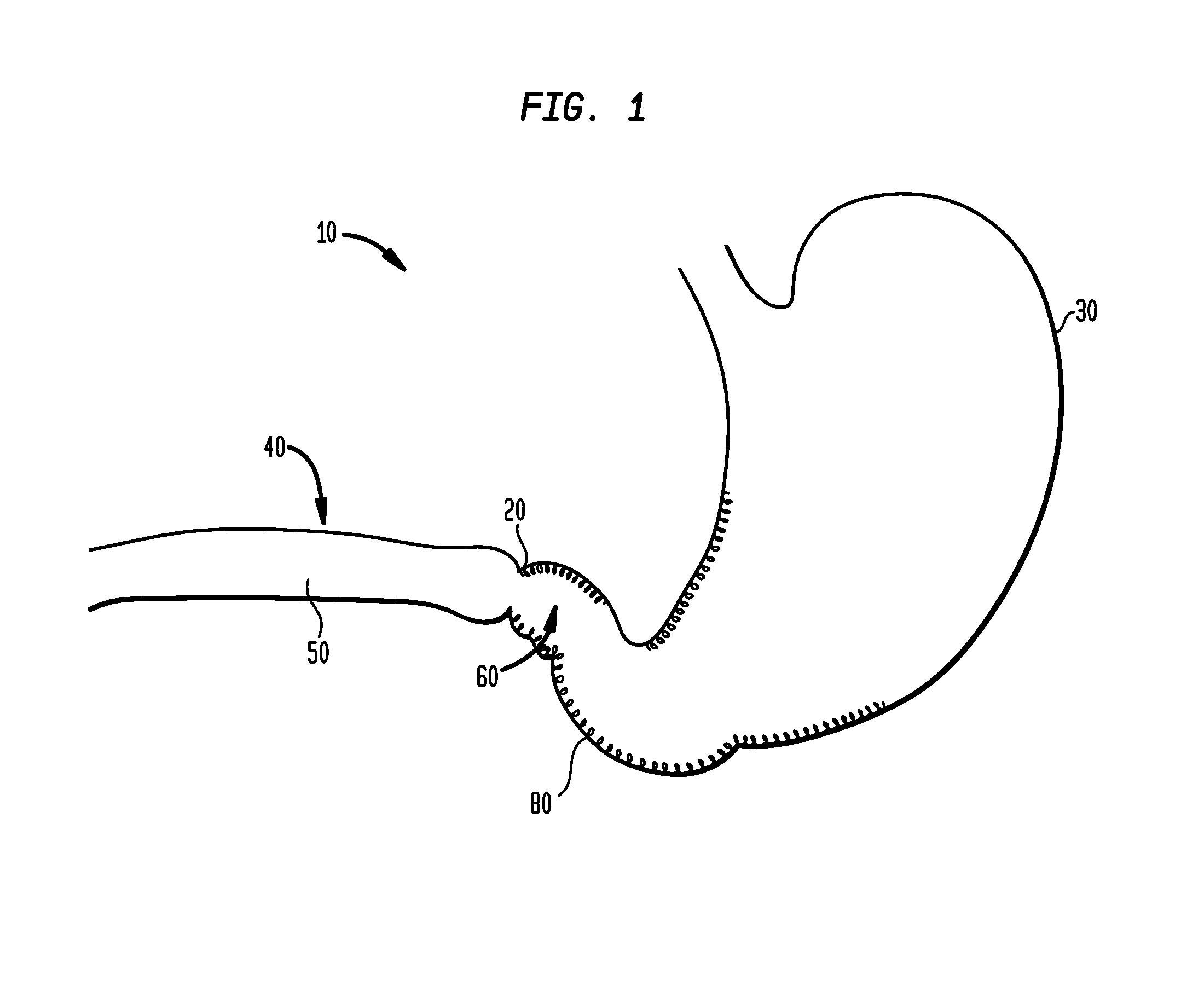 Systems and methods for treatment of obesity and type 2 diabetes