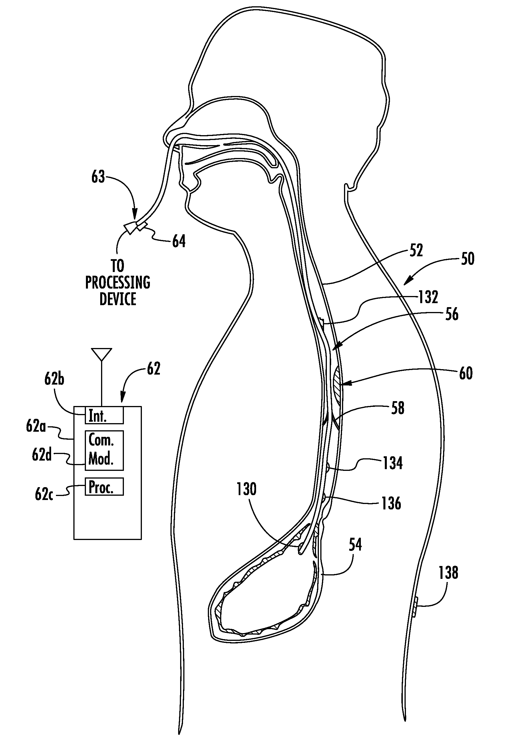 Device with active valve to block emesis and reflux blockage device and associated system and method