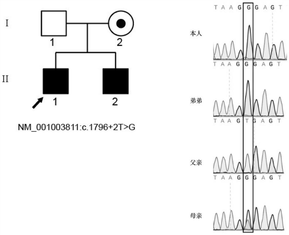 Application of TEX11 gene pathogenic mutation in preparation of diagnostic kit for detecting non-obstructive azoospermia