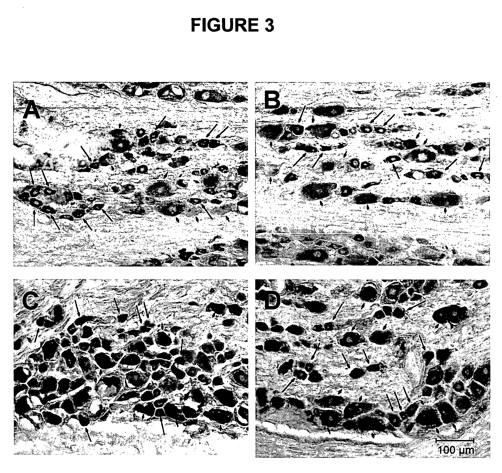 Method of alleviating chronic pain via peripheral inhibition of neurotransmitter synthesis