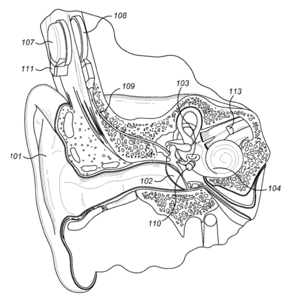 Incus Short Process Attachment for Implantable Float Transducer