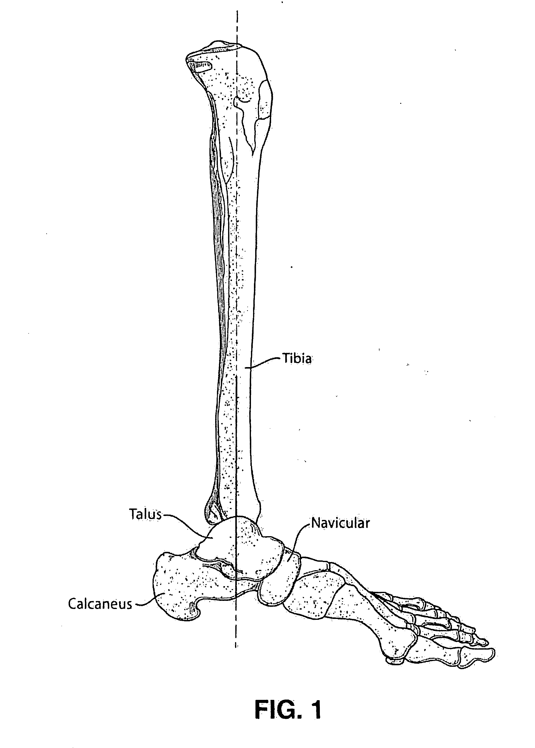 Intramedullary locked compression screw for stabilization and union of complex ankle and subtalar deformities