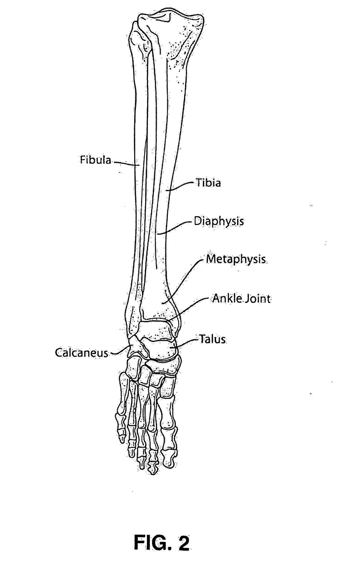 Intramedullary locked compression screw for stabilization and union of complex ankle and subtalar deformities