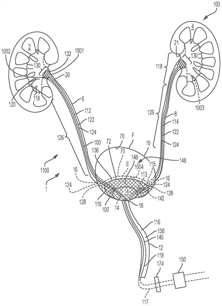 Coated and/or impregnated ureteral catheter or stent and manufacturing method thereof