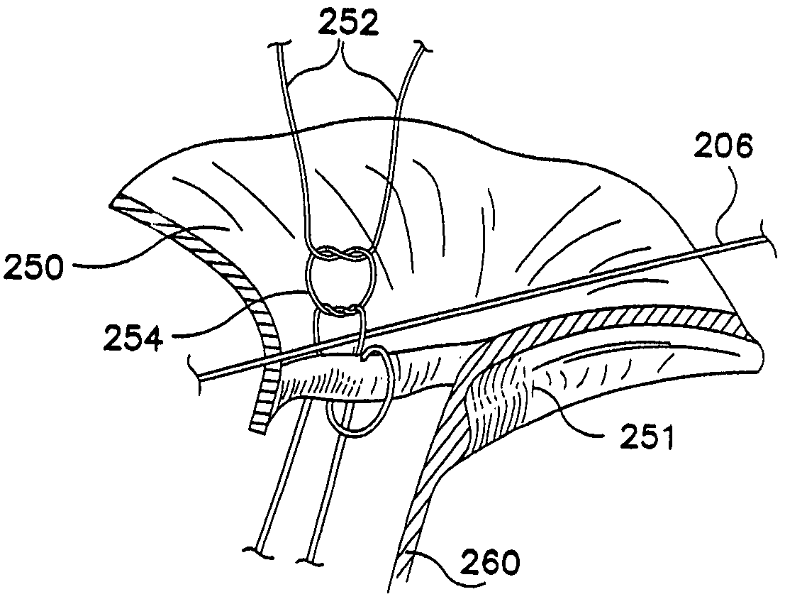 Flexible annuloplasty prosthesis and holder