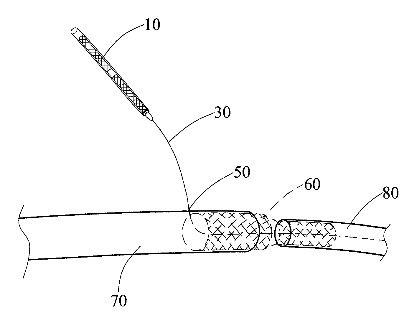 Endovascular stent insertion method