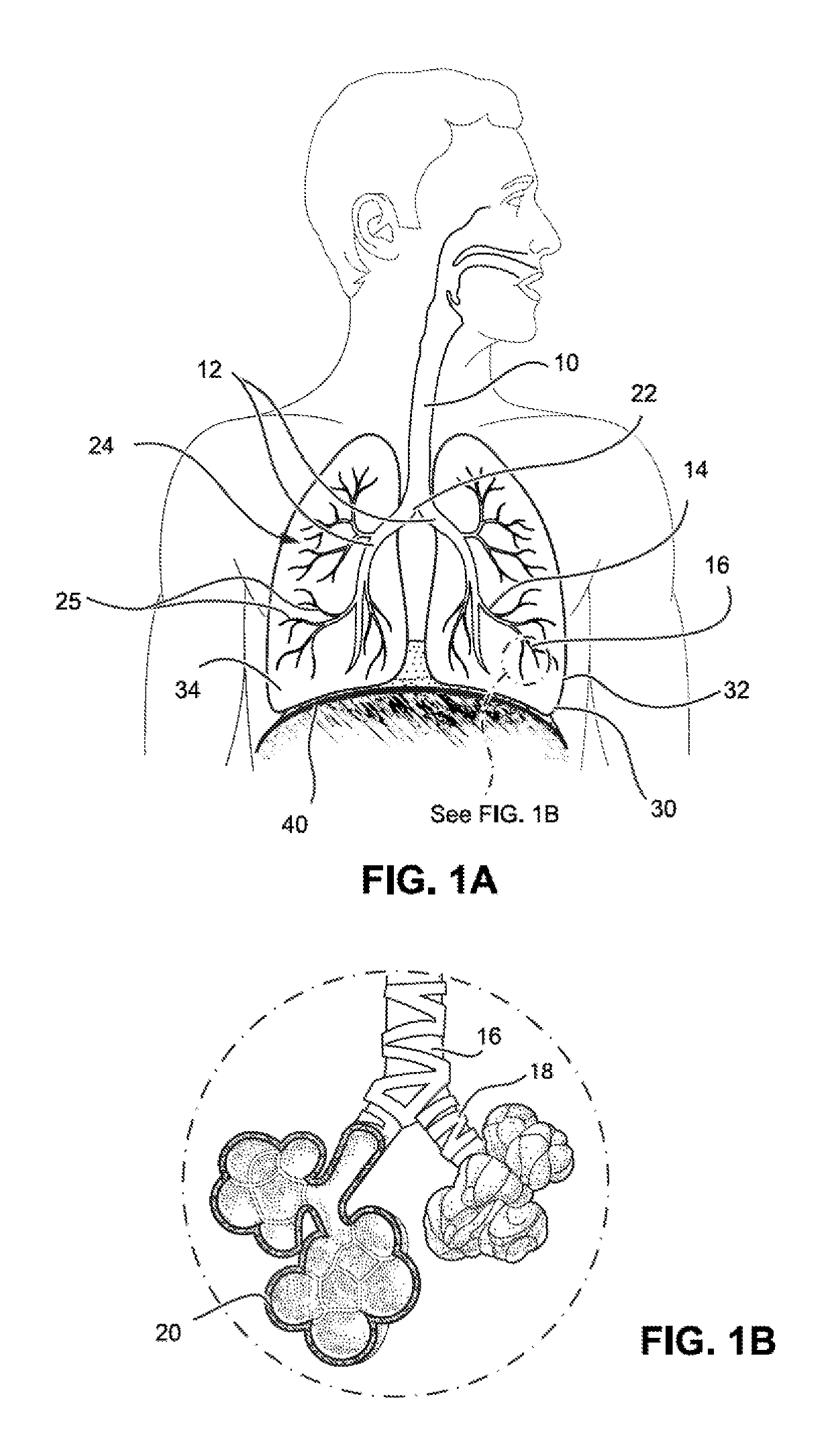 Methods and devices for the treatment of pulmonary disorders