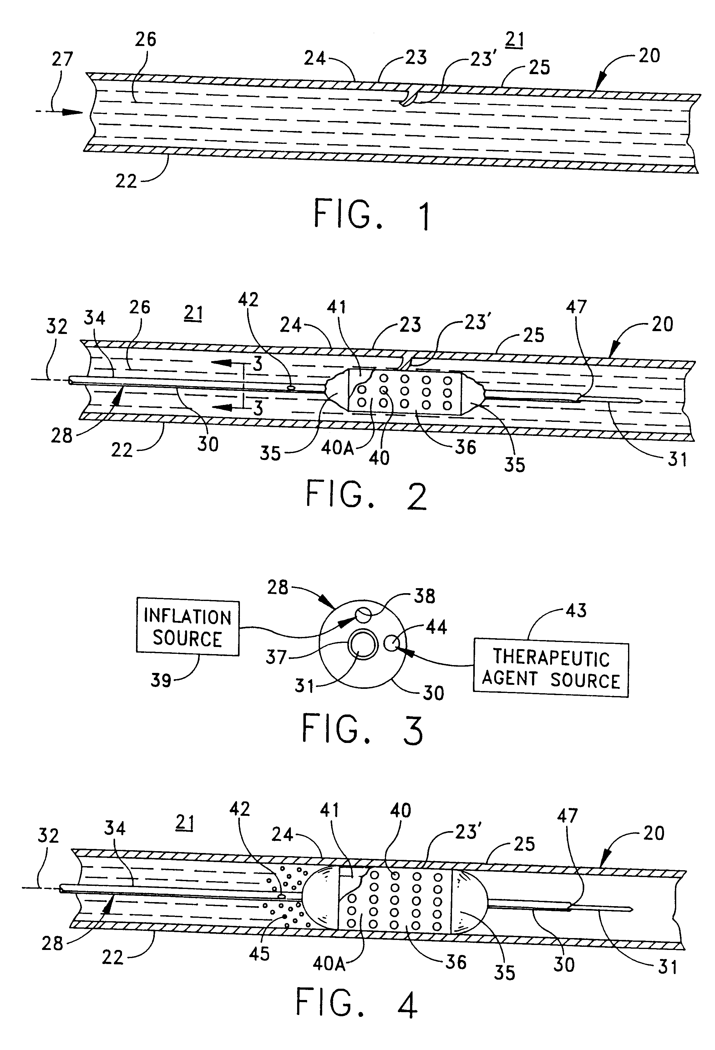 Replenishable stent and delivery system