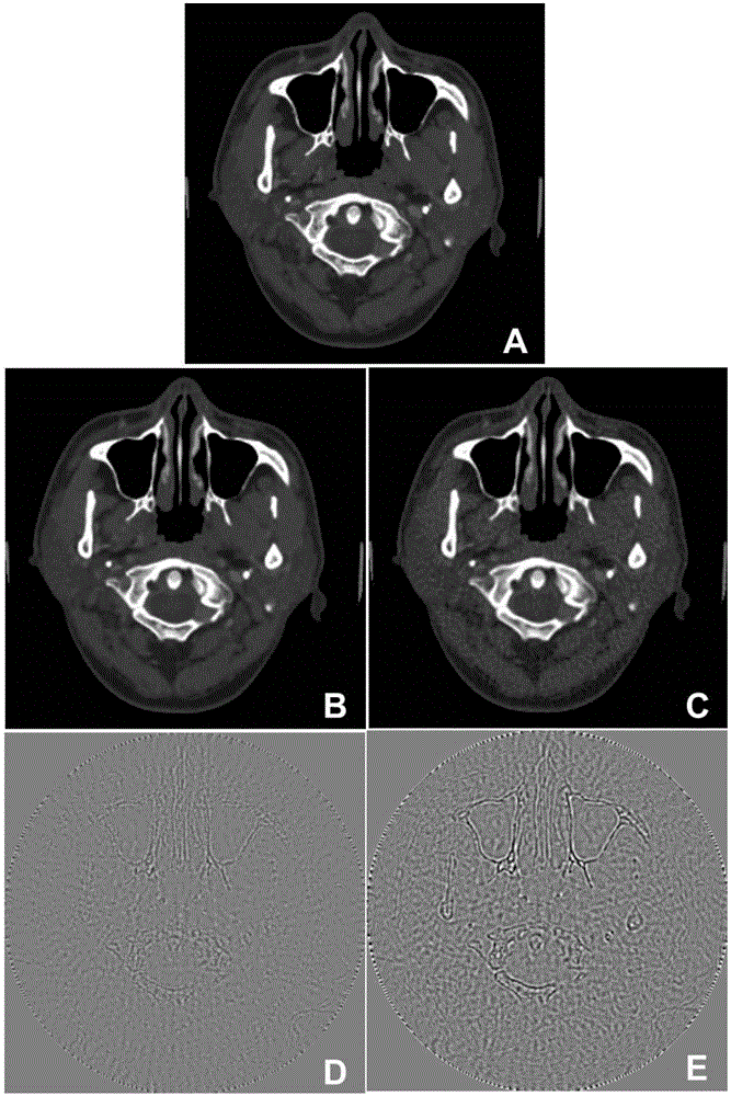 Undersampled CT image reconstruction method