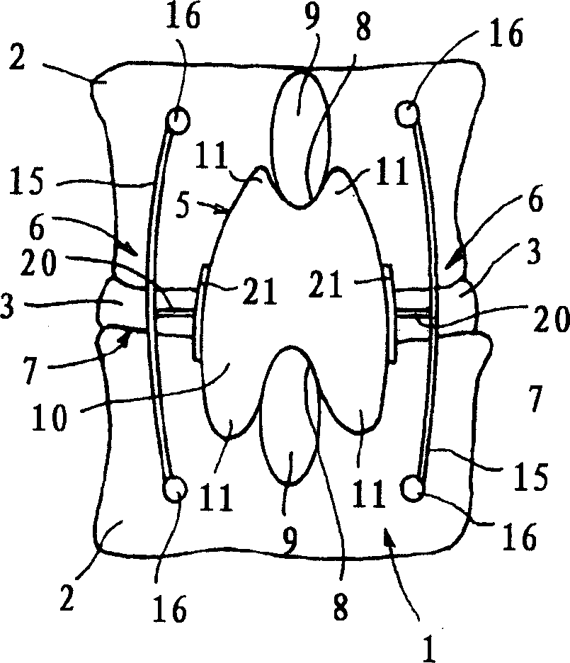 Posterior vertebral support assembly