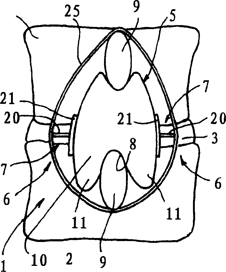 Posterior vertebral support assembly