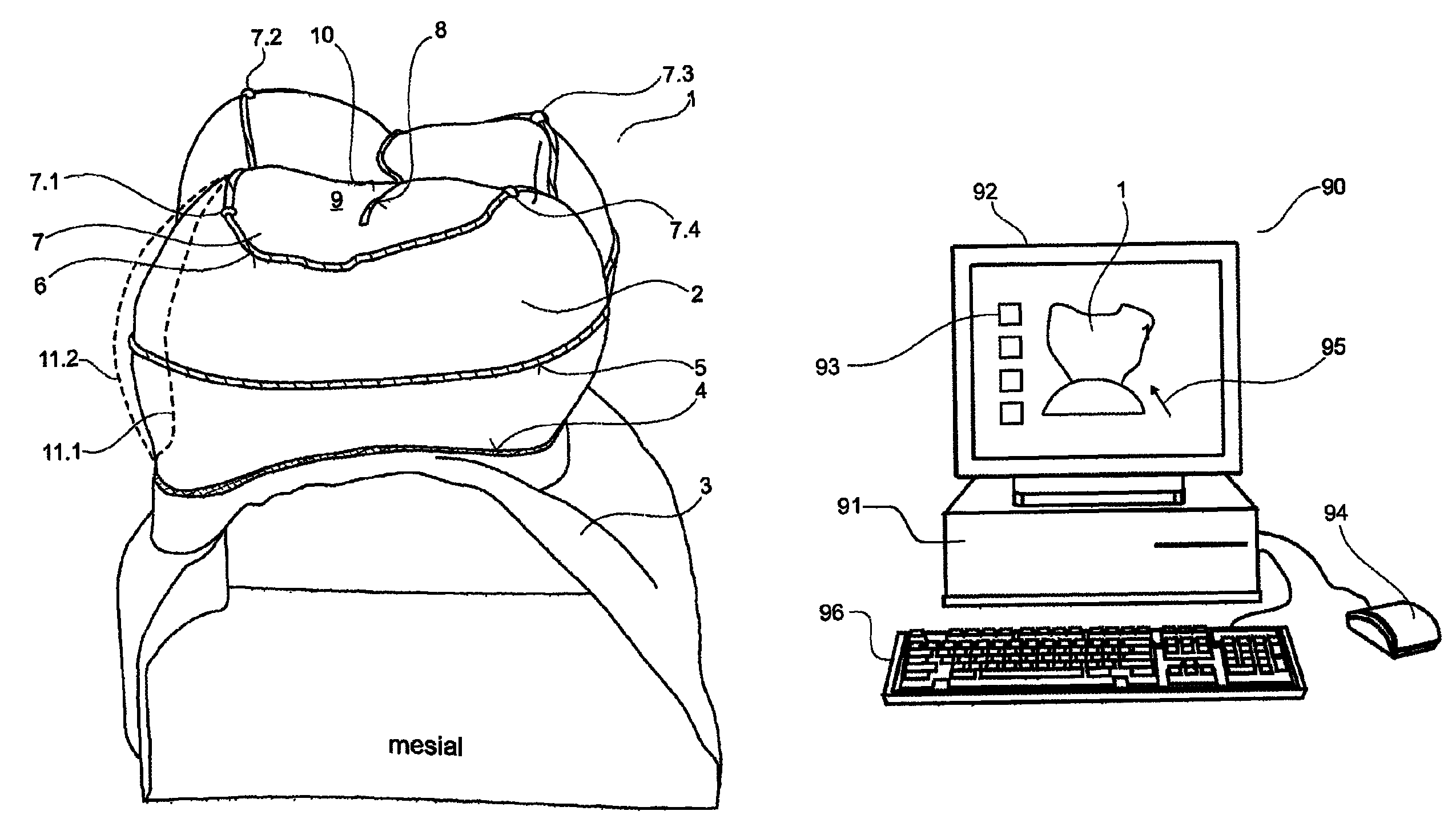 Device for selecting an area of a dental restoration body, which is depicted in a 3D representation, and method therefor