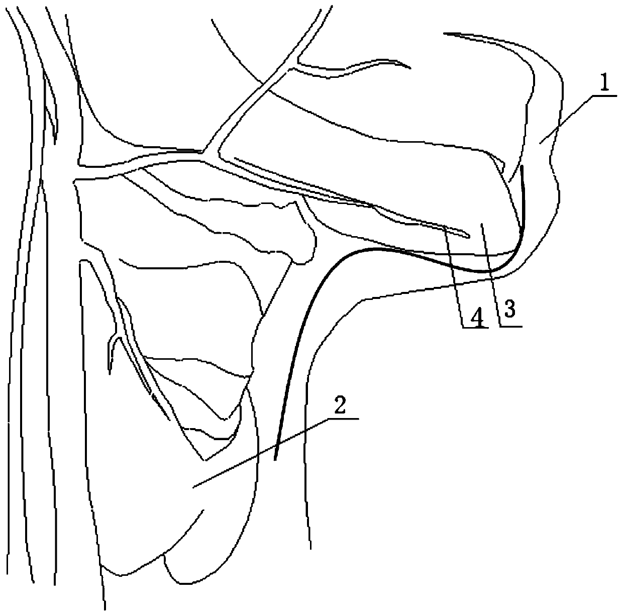 Inflation-free thyroid retractor