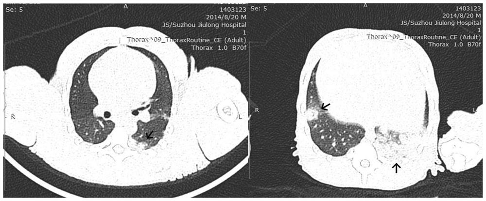 Pulmonary arterial hypertension non-human primate model and construction method thereof