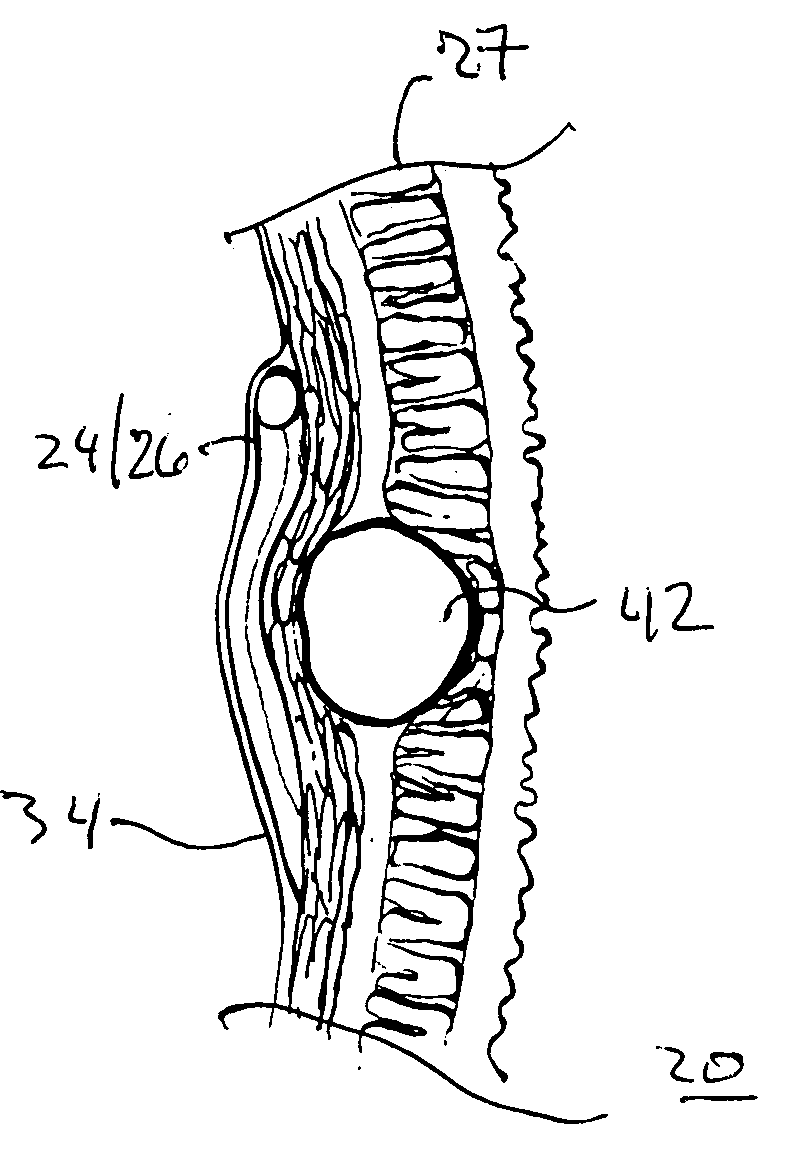 Vagal nerve bulking arrangement