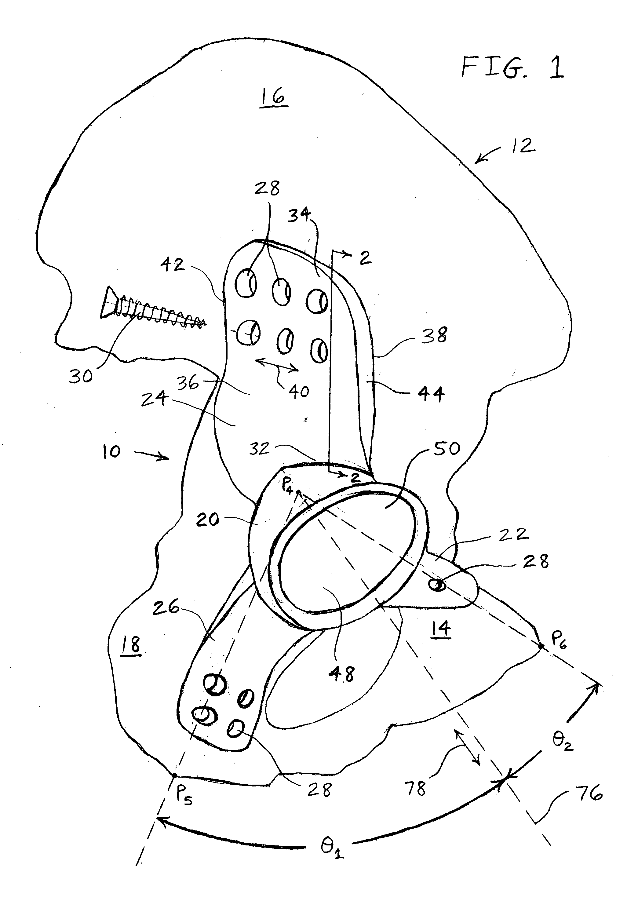 Customized prosthesis and method of designing and manufacturing a customized prosthesis by utilizing computed tomography data