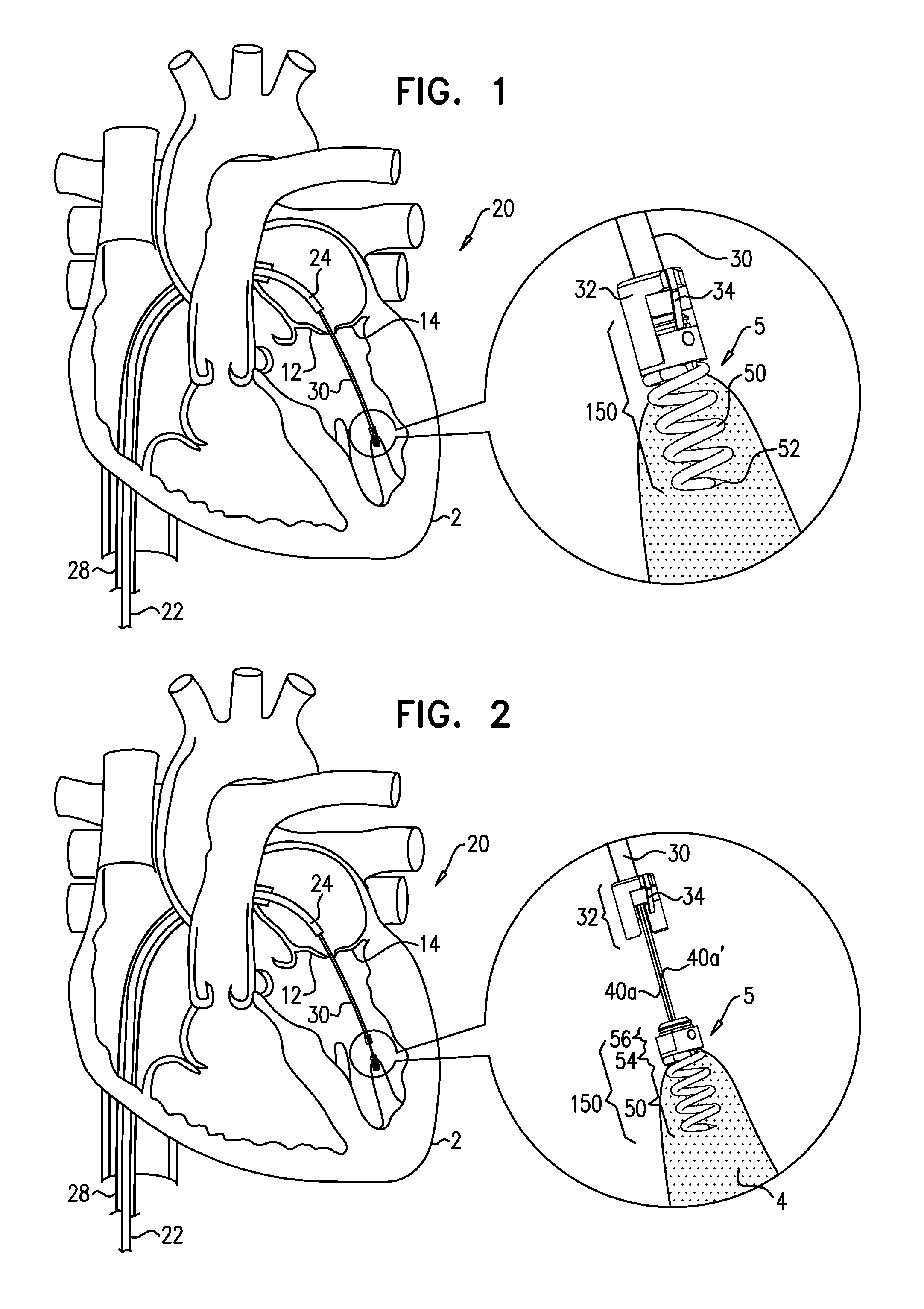 Apparatus and method for guide-wire based advancement of a rotation assembly